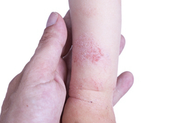 革螨皮炎胳膊脱屑图 革螨皮炎胳膊脱屑图