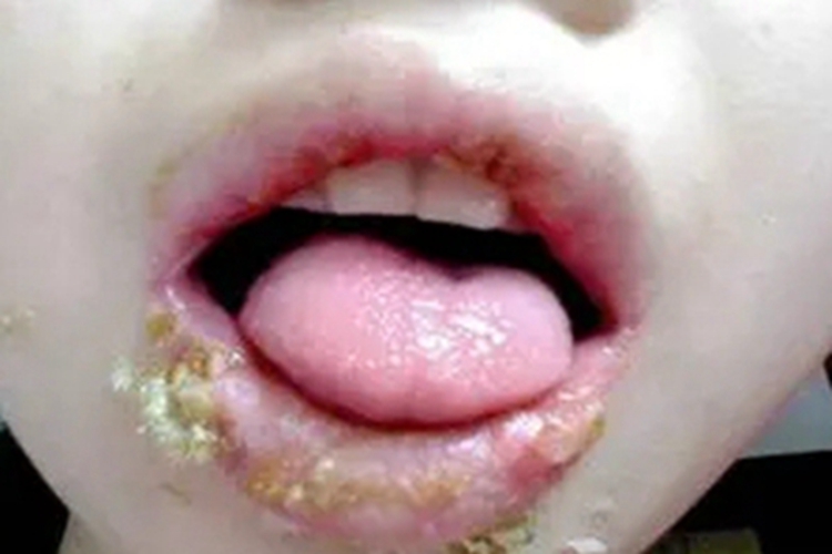 浆细胞性唇炎结痂图 浆细胞性唇炎结痂图