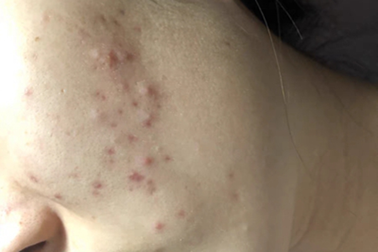 痤疮左脸上有很多硬疙瘩图 痤疮左脸上有很多硬疙瘩图