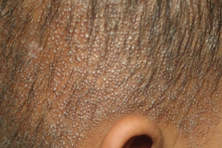 毛囊角化病头皮症状图