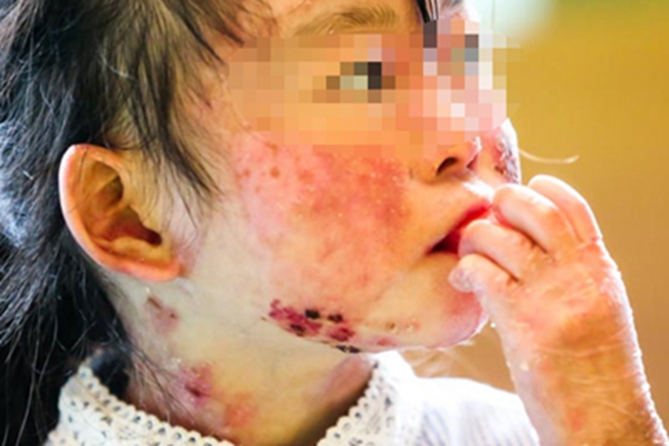 交界型大疱性表皮松解症图