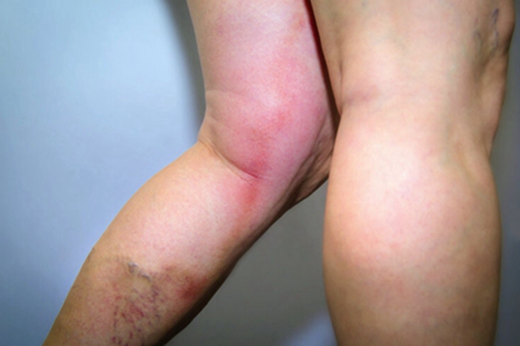 下肢深静脉血栓形成肿胀图 下肢深静脉血栓形成肿胀图