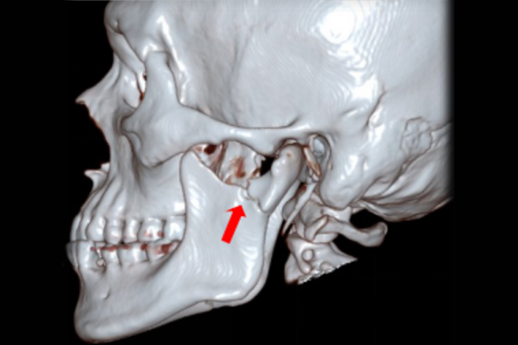 髁突矢状骨折图 髁突矢状骨折图