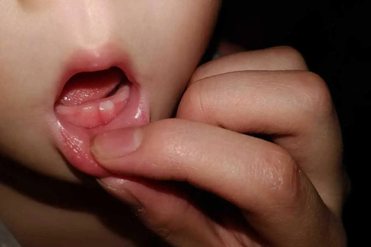 萌出性龈炎图 萌出性龈炎图