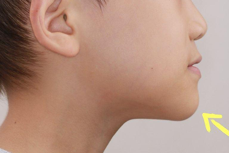 下颌发育畸形轻微前突图 下颌发育畸形轻微前突图