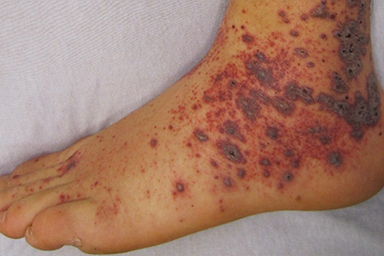 小儿过敏性紫癜脚踝外侧有紫斑图 小儿过敏性紫癜脚踝外侧有紫斑图