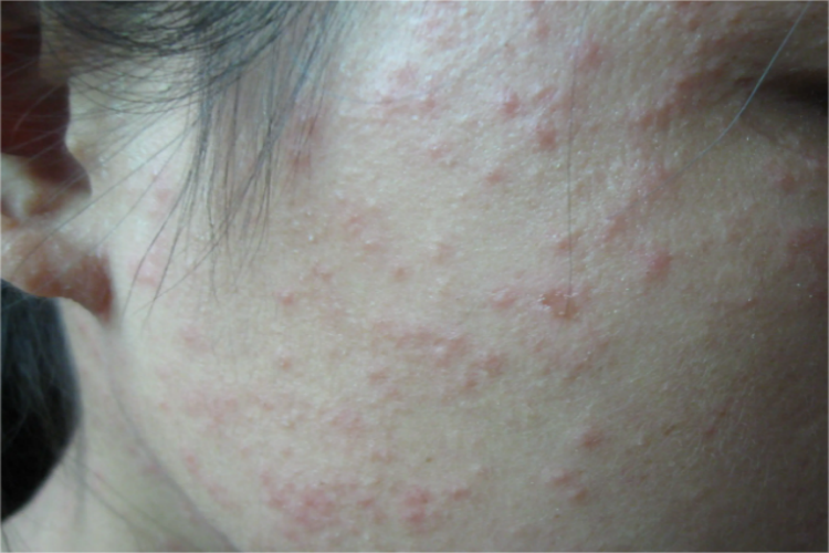 玫瑰疹图 玫瑰疹图