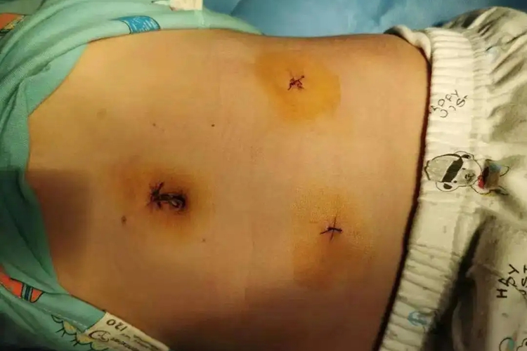 腹腔镜阑尾切除术图