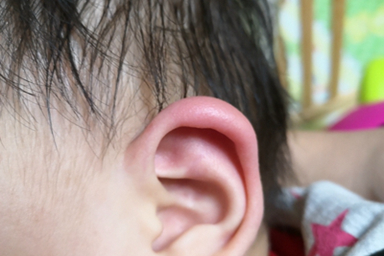 耳廓软骨膜炎耳廓红肿图 耳廓软骨膜炎耳廓红肿图