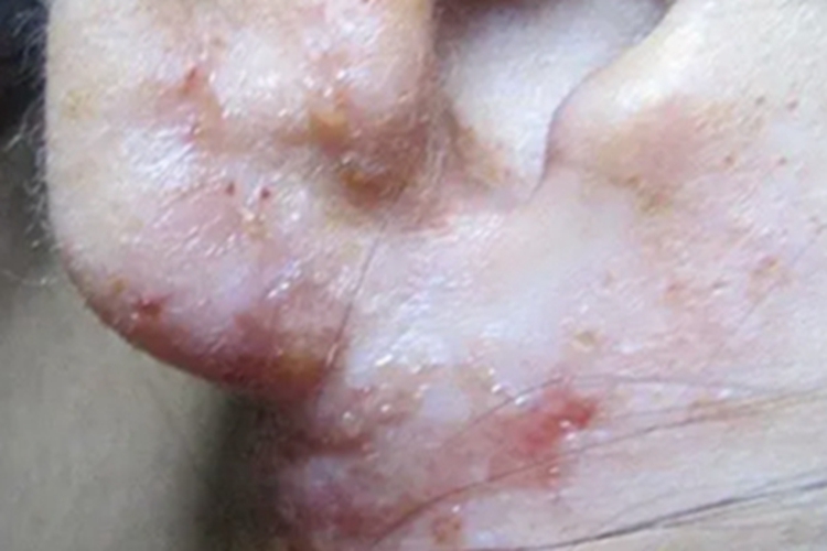 感染性湿疹耳朵发红流黄水图