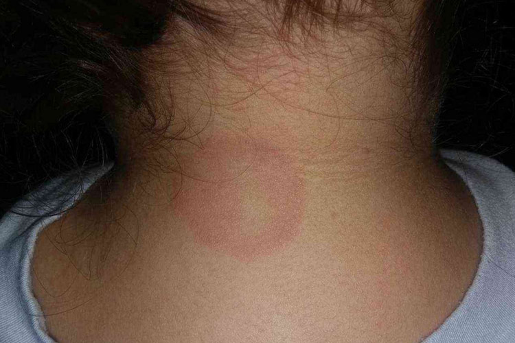 儿童体癣图 儿童体癣图