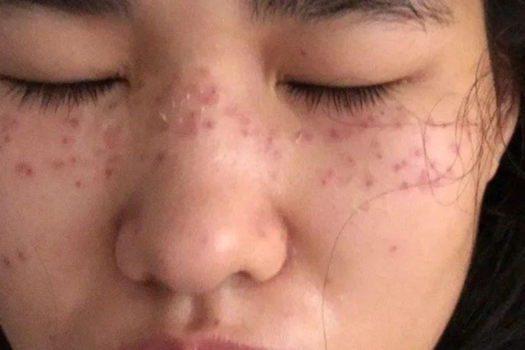 激光祛斑局部红肿图