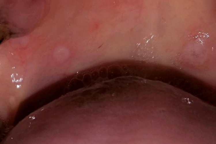 白血病儿童口腔溃烂图