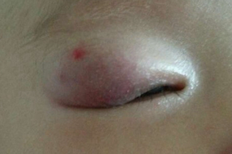 小儿血管瘤肿图