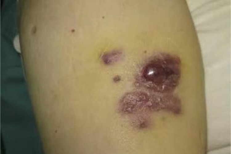 淋巴水肿相关性血管肉瘤症状图