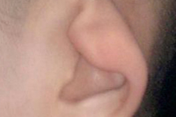 重度杯状耳耳廓症状图 重度杯状耳耳廓症状图