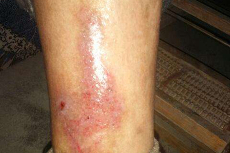 水蛭咬伤红肿图 水蛭咬伤红肿图