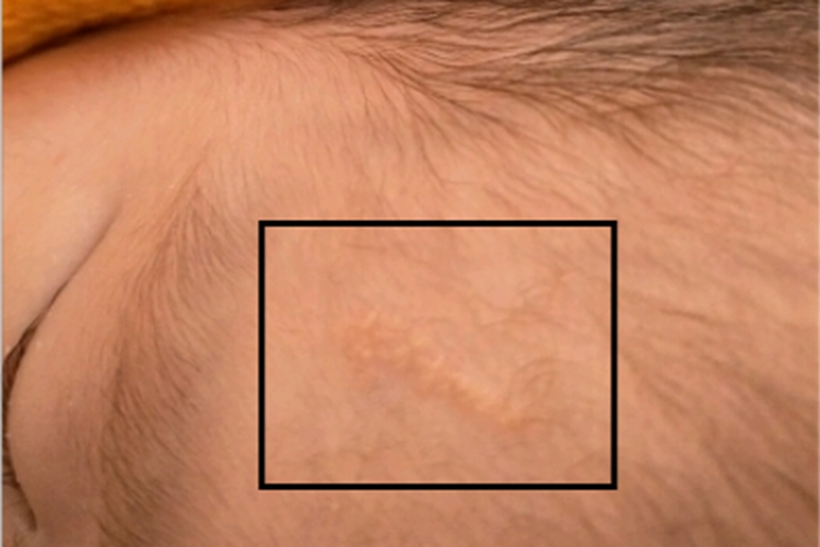 皮脂腺痣前额结节图 皮脂腺痣前额结节图