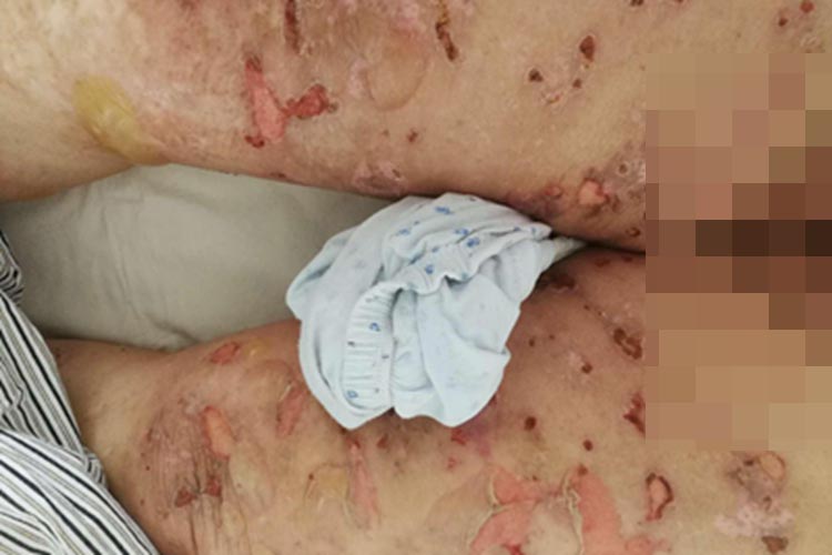 增殖型天疱疮大腿水疱图