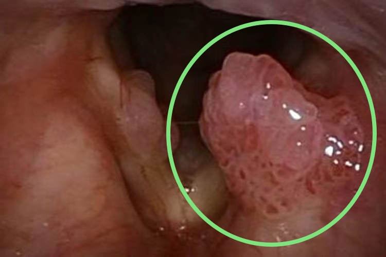 喉癌内窥镜下图