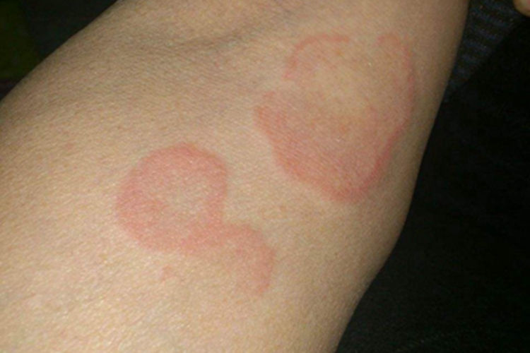 毛细血管扩张性环状紫癜症状图 毛细血管扩张性环状紫癜症状图