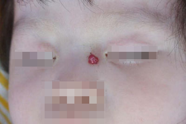 良性幼年黑色瘤眼角硬疙瘩图