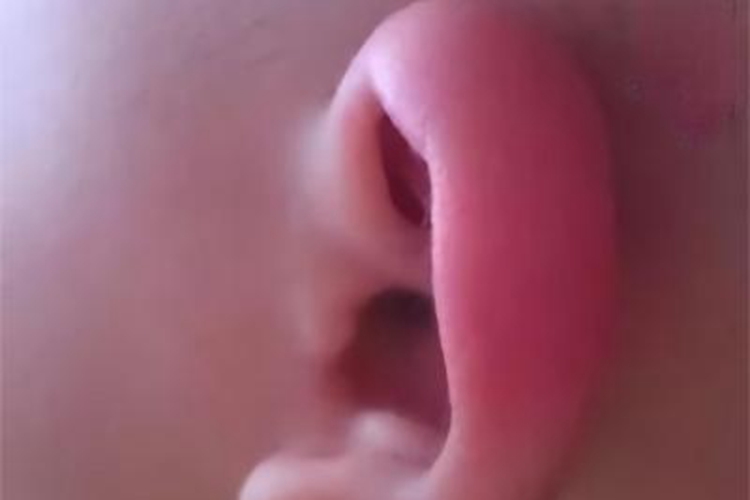 耳廓化脓性软骨膜炎耳廓红肿图 耳廓化脓性软骨膜炎耳廓红肿图