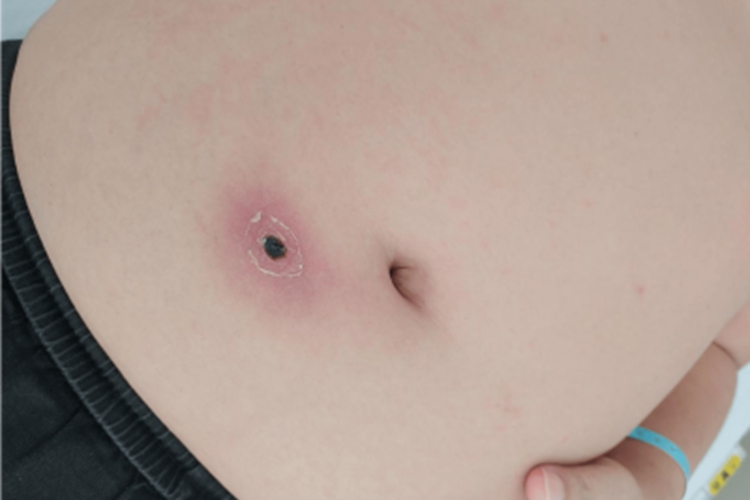 恙虫病腹部症状图