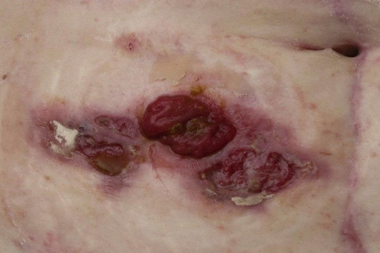 慢性乳头状溃疡性脓皮病溃疡图