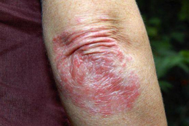 亚急性皮肤型红斑狼疮手肘红斑图