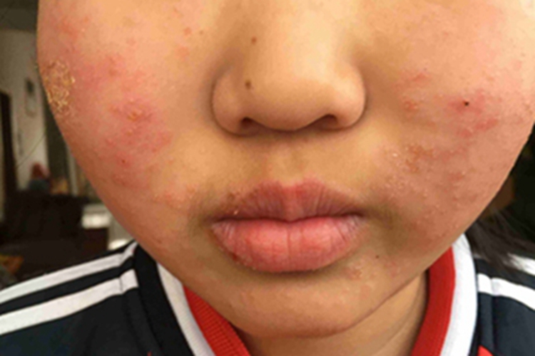 光线性痒疹皮肤粗糙图