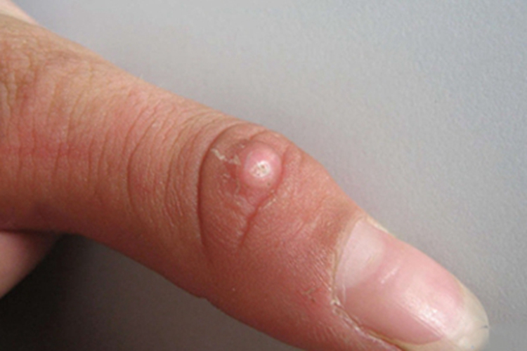 硬化性脂肪肉芽肿手指症状图 硬化性脂肪肉芽肿手指症状图