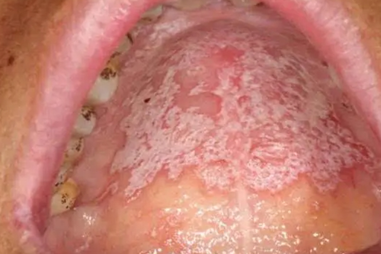 艾滋病初期口腔感染白念珠菌图 艾滋病初期口腔感染白念珠菌图