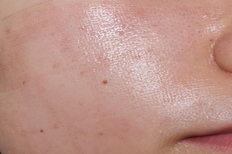 点阵激光后红肿图