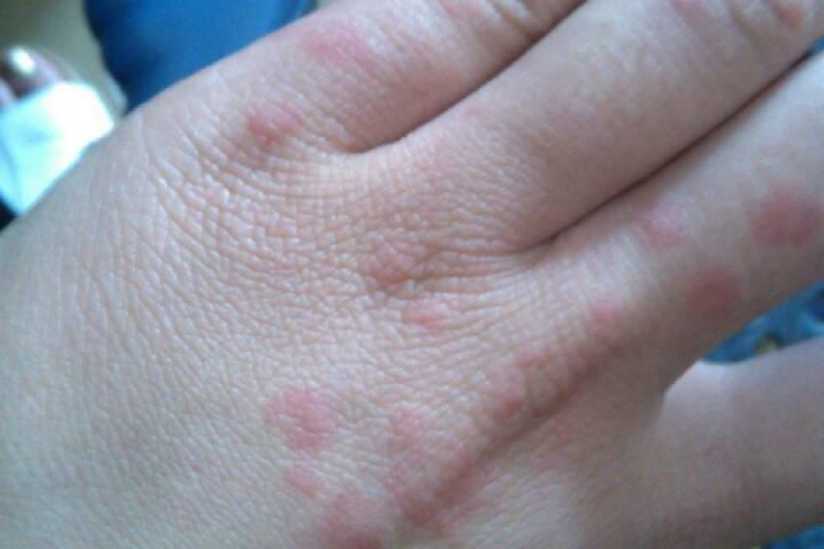 柚子过敏起红斑图