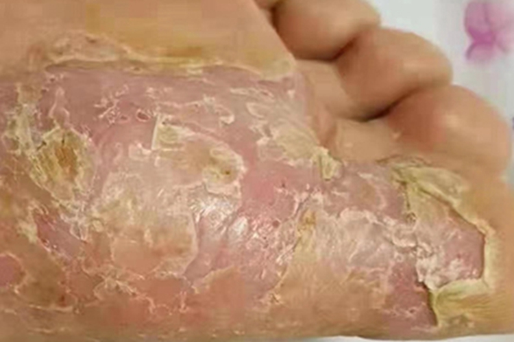 掌跖脓疱病脚底皮肤增厚图 掌跖脓疱病脚底皮肤增厚图