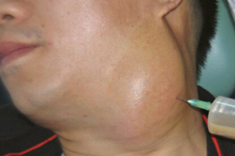 鳃裂囊肿症状图