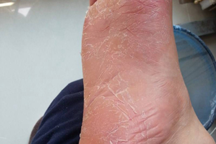 条纹状掌跖角化病脚底脱屑图