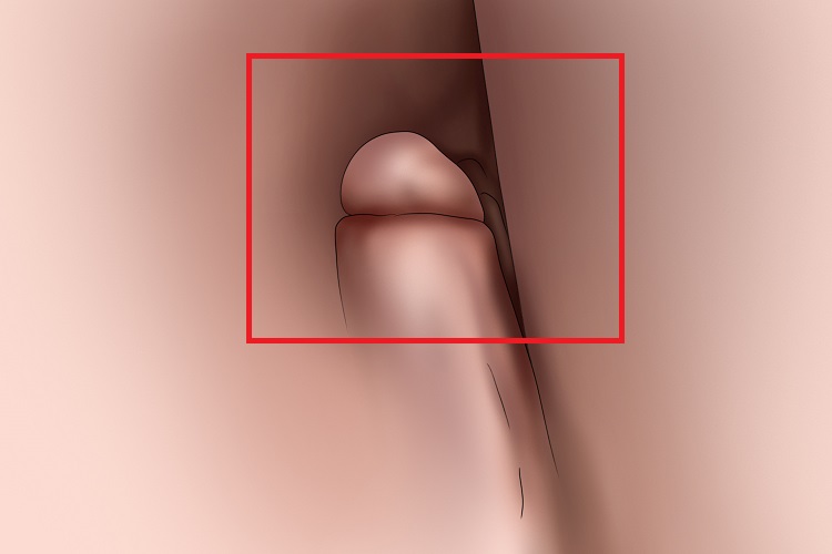 肛乳头瘤肛门小疙瘩图 肛乳头瘤肛门小疙瘩图
