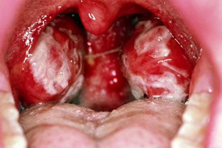 急性滤泡性扁桃体炎化脓图