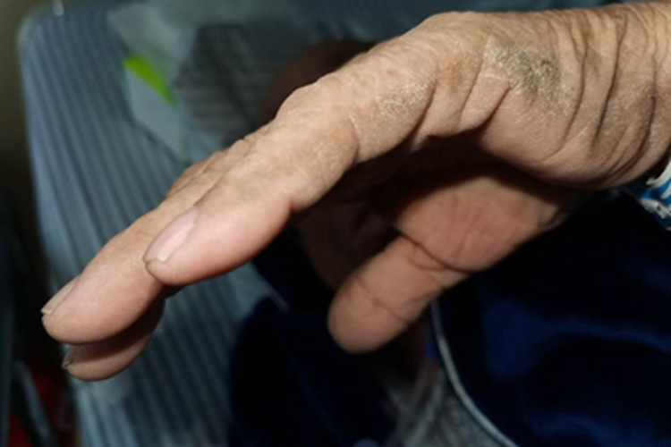 恶性黑棘皮病手部粗糙图