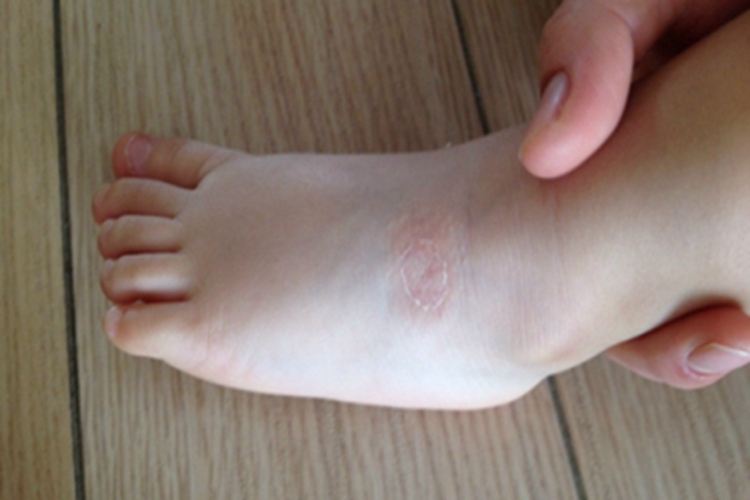 急性点滴型儿童银屑病脚背脱屑图 急性点滴型儿童银屑病脚背脱屑图