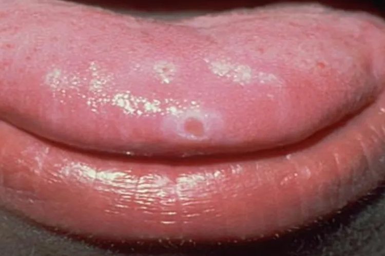 小孩复发性阿弗他溃疡图