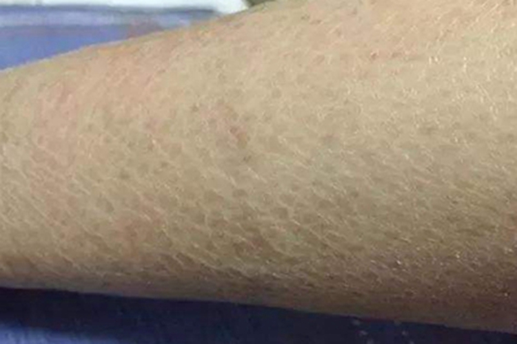 缺铁性贫血皮肤粗糙图