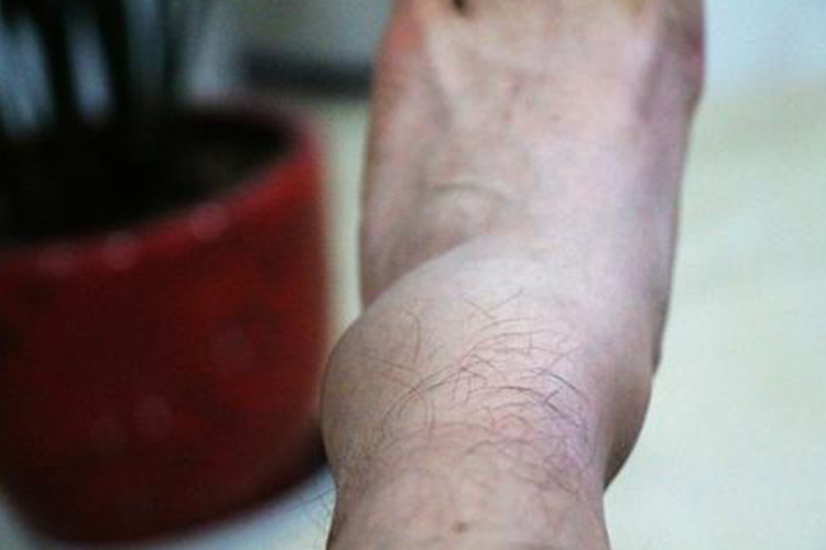 脚踝扭伤局部肿胀图 脚踝扭伤局部肿胀图