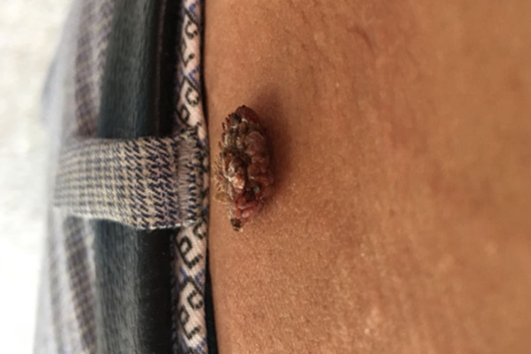 腰部长寻常疣图