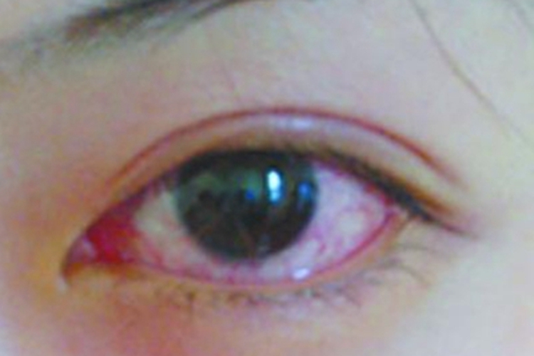 儿童过敏性结膜炎眼睛出现血丝图