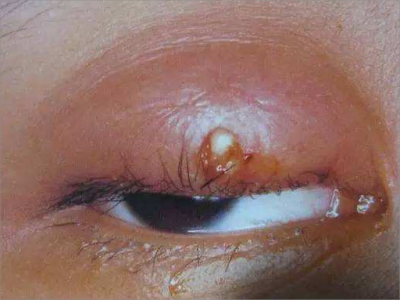 眼睑脓肿上眼睑红肿伴白色小脓包图