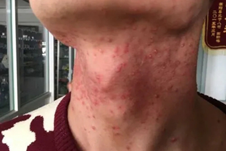 马拉色菌毛囊炎颈部疙瘩图 马拉色菌毛囊炎颈部疙瘩图