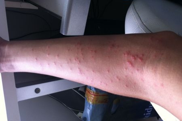 手臂普通红点症状图